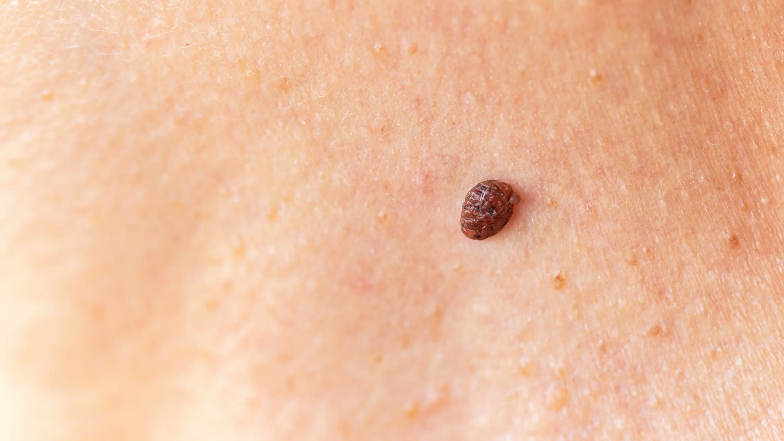 Common Lumps and Bumps | Parkwood Skin Clinic