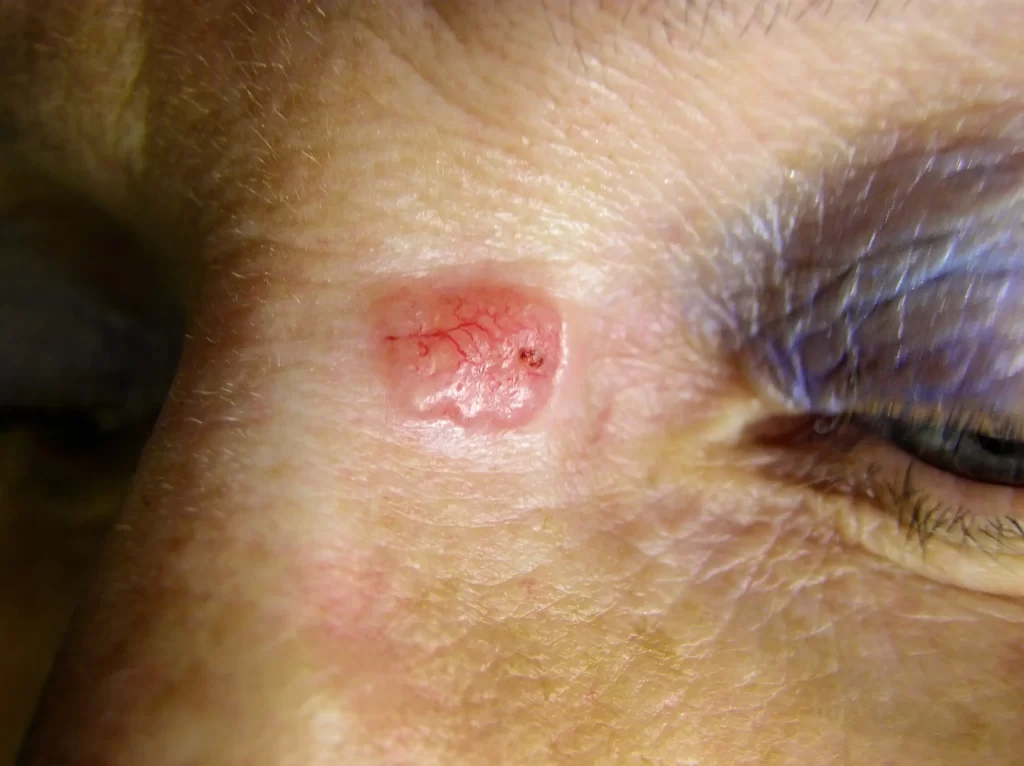 basal cell carcinoma nose