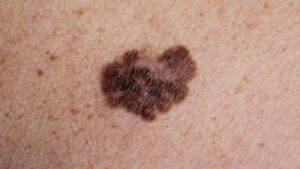 superficial spreading melanoma