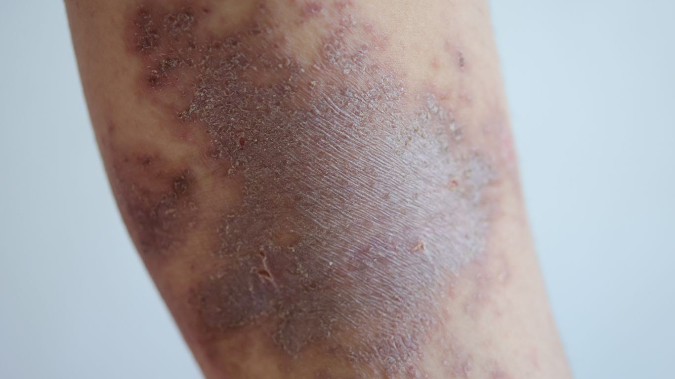 Skin Rashes Treatment Gold Coast | Parkwood Skin Clinic