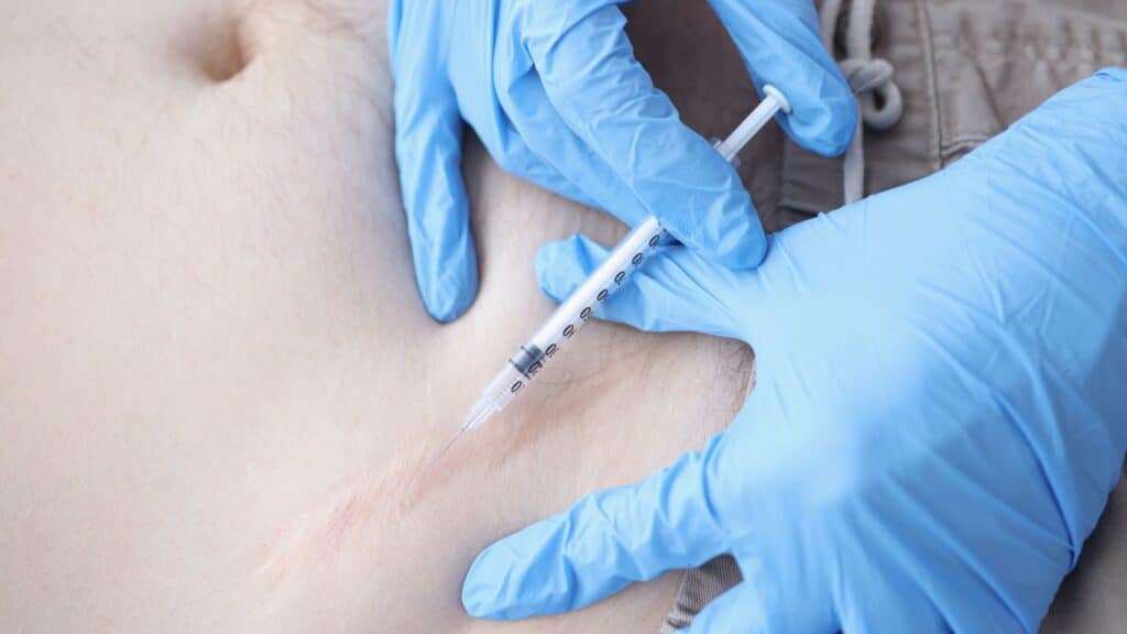 keloid injection