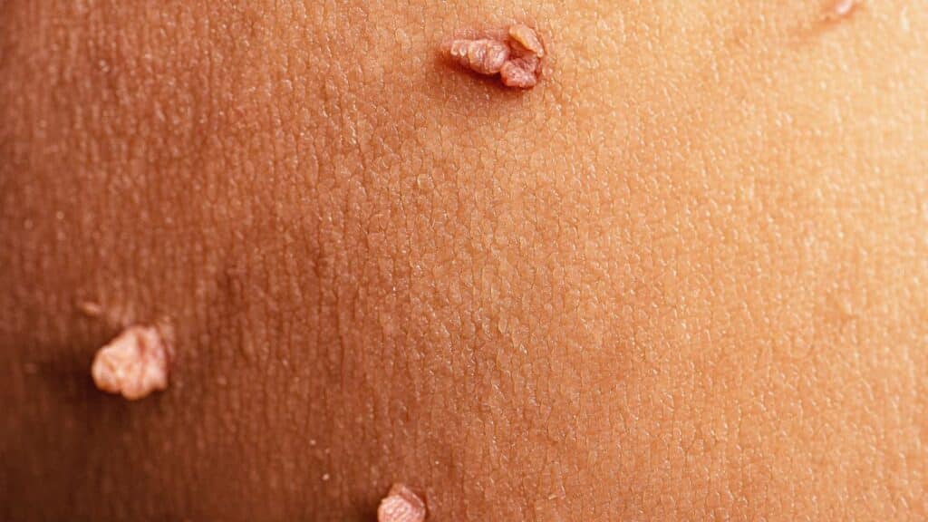 skin tags