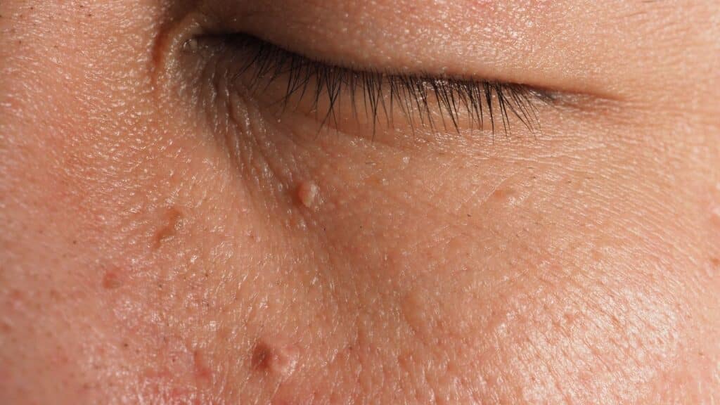 skin tags under the eyes