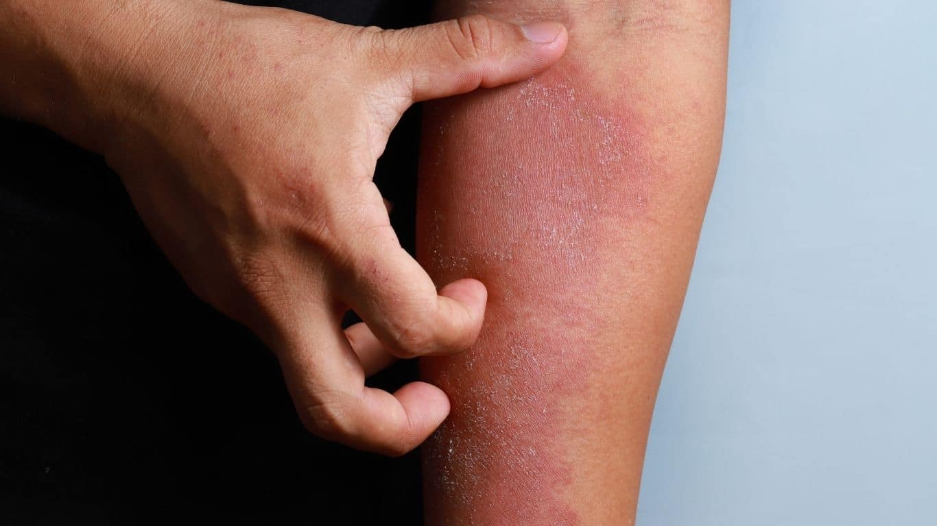 A patient with eczema on his legs is seeking help at Parkwood Skin Clinic.