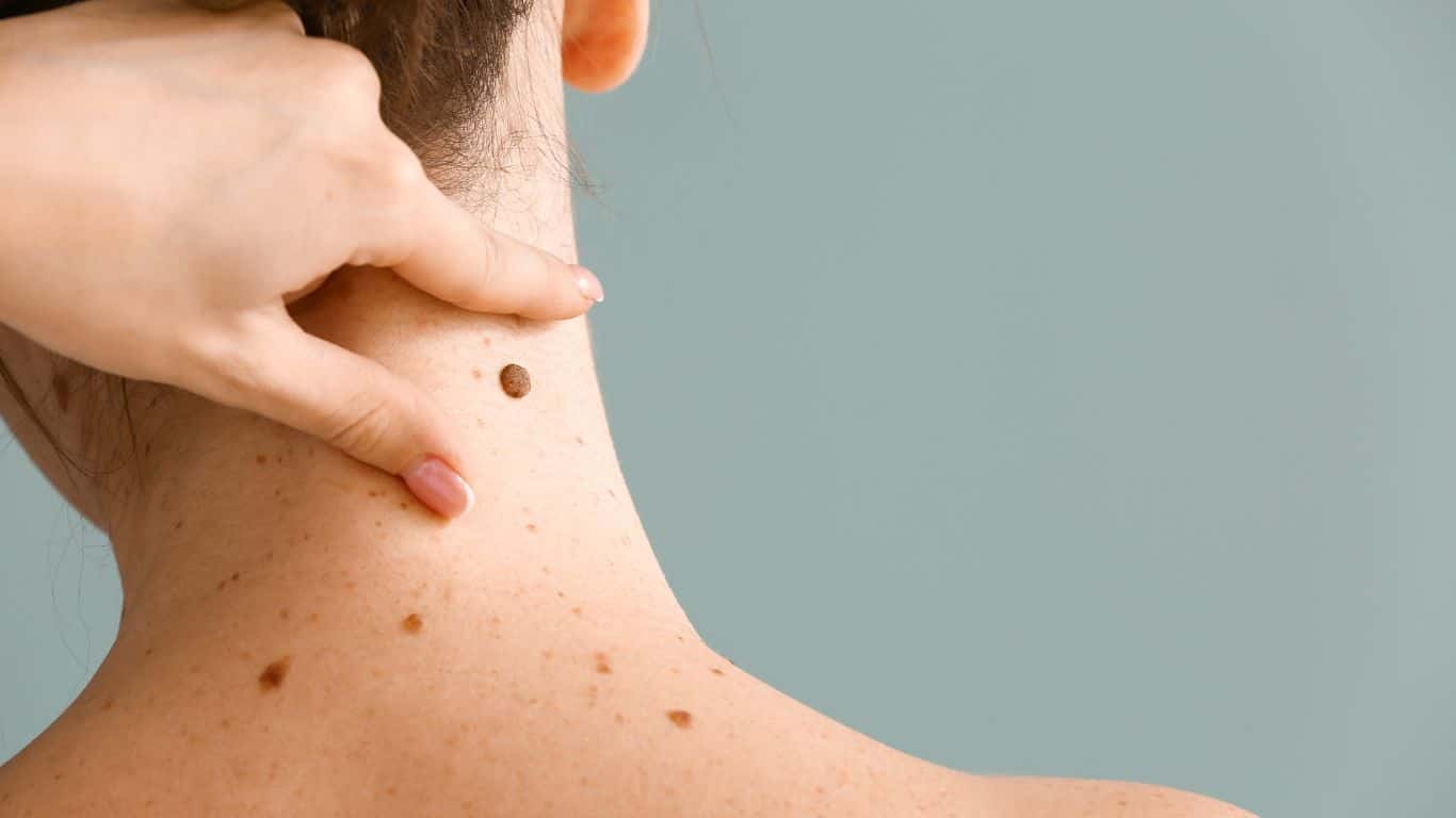 moles on the neck