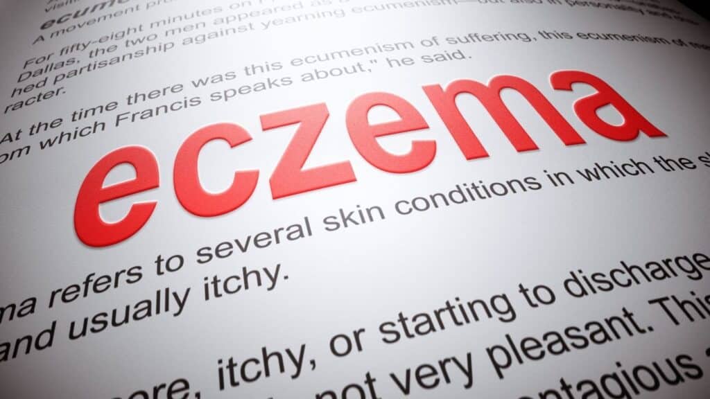 eczema definition