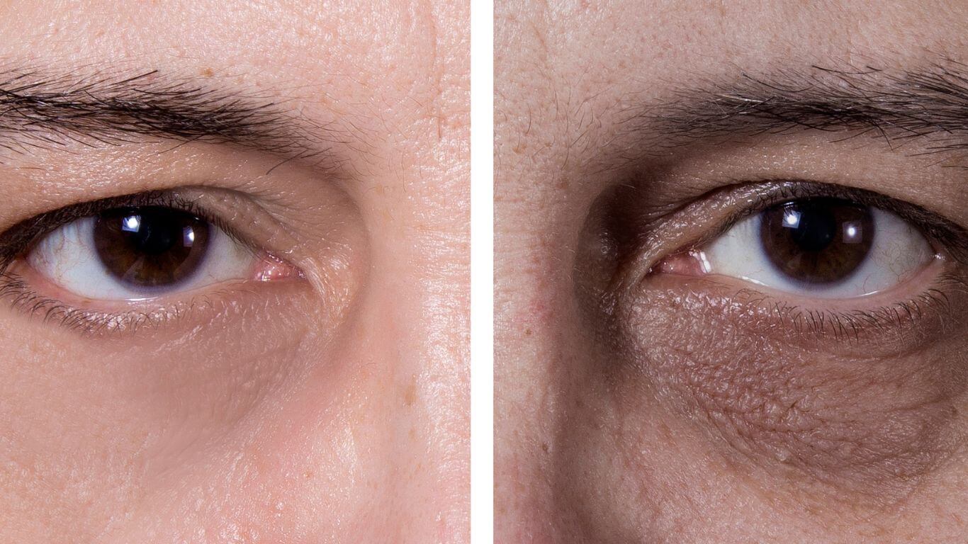 A Parkwood Skin Clinic patient is showing dark circles under his eyes