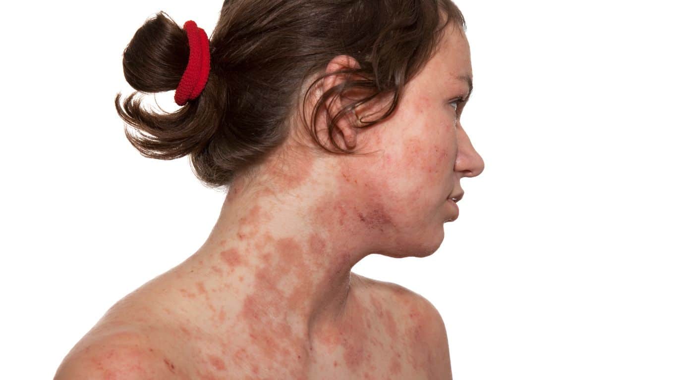 A female patient at Parkwood Skin Clinic has been diagnosed with eczema on her face.