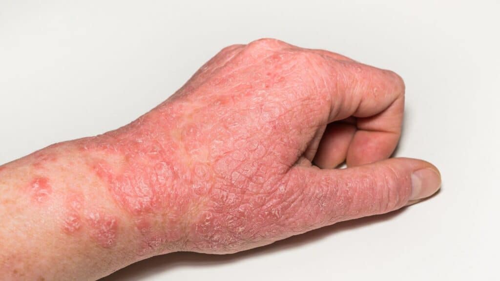 A patient at Parkwood Skin Clinic has been diagnosed with dyshidrotic eczema on his hand.