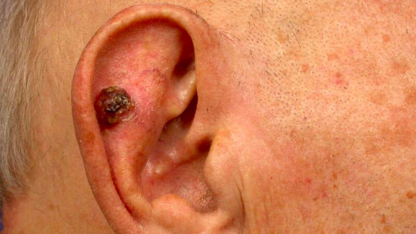 Skin Cancer of the Ear and Surgical Reconstruction Options ...