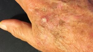 A Parkwood Skin Clinic patient hand with squamous cell carcinoma