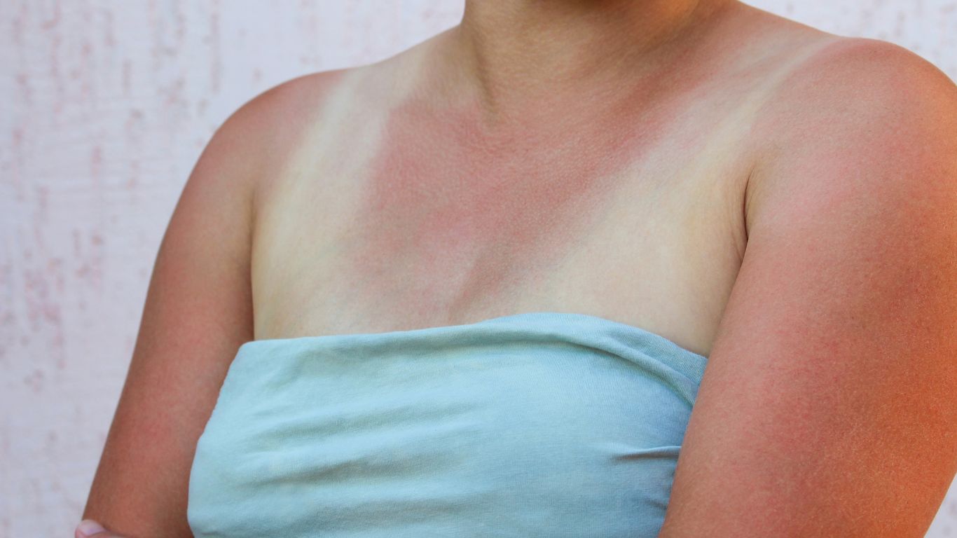 sunburn chest on a young woman