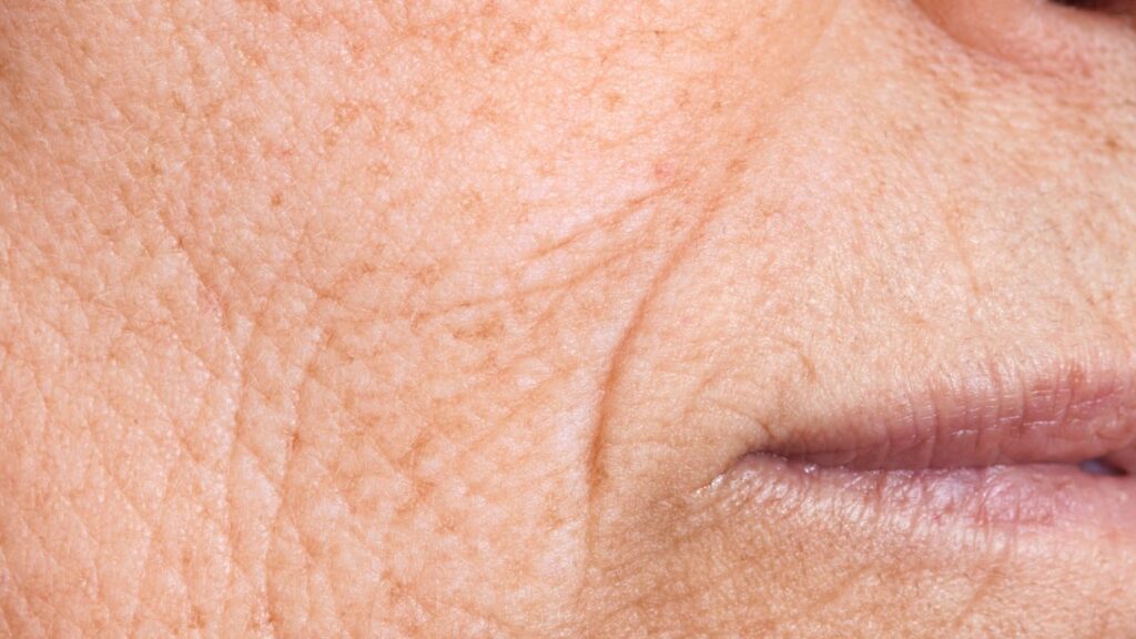 fine wrinkles on the right cheek