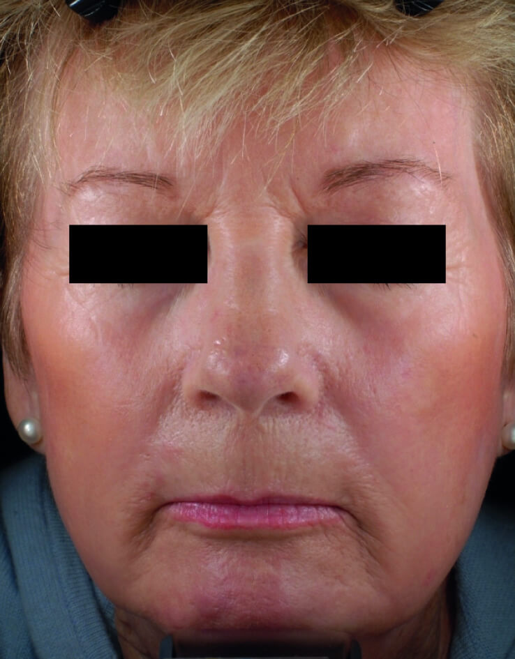 An after image of a woman showcasing the results of a facial procedure she had done at Parkwood Skin Clinic