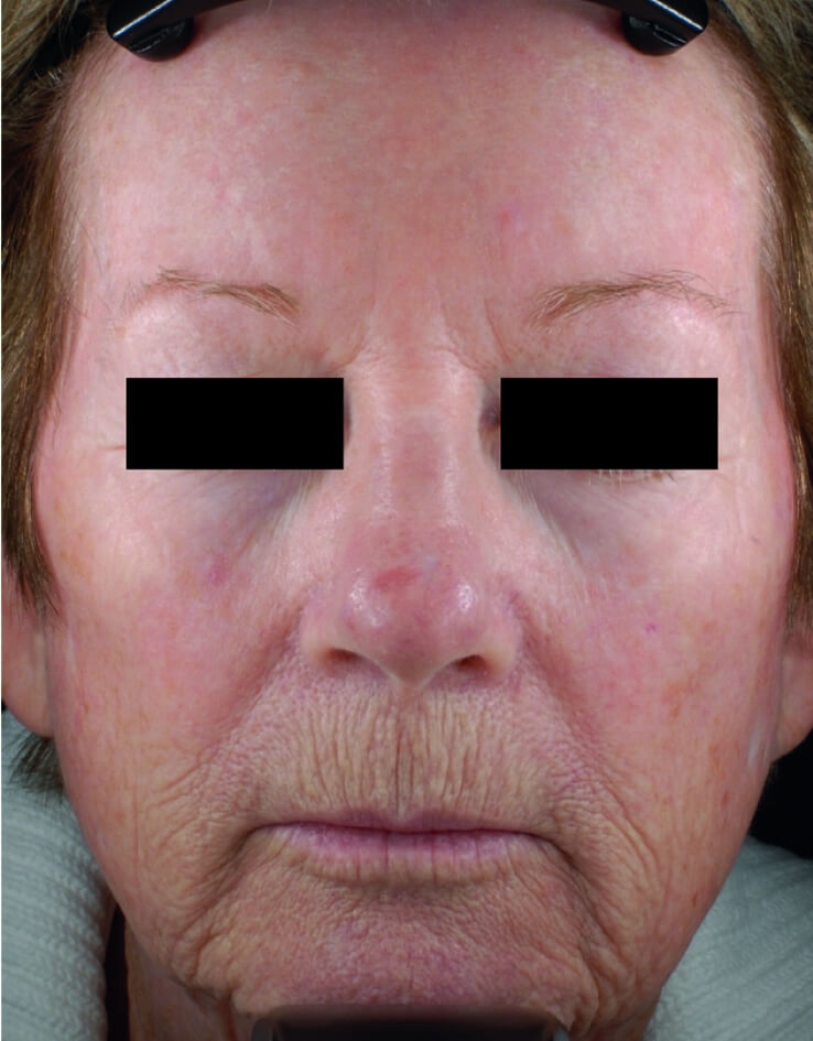 A woman is showcasing her wrinkles before her treatment at Parkwood Skin Clinic