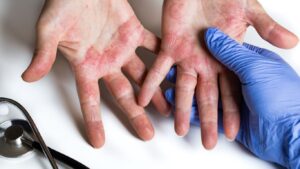 contact dermatitis