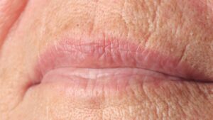 perioral wrinkles